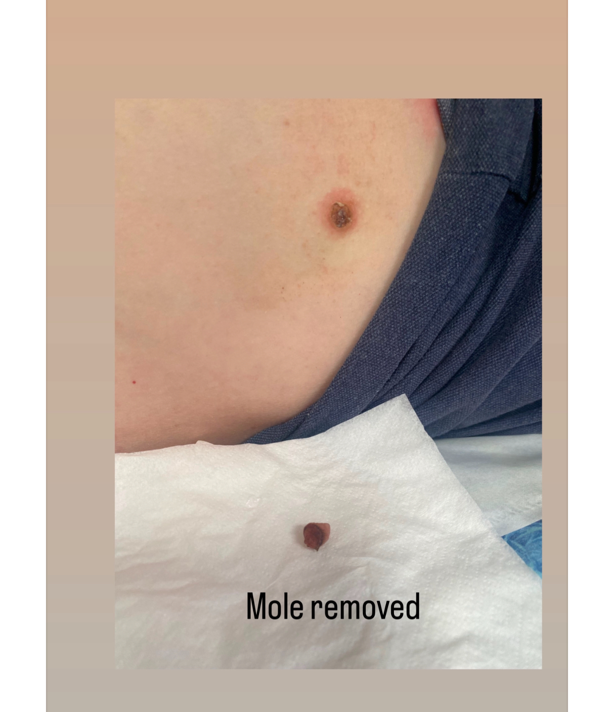 Mole and Skin Tag Removal